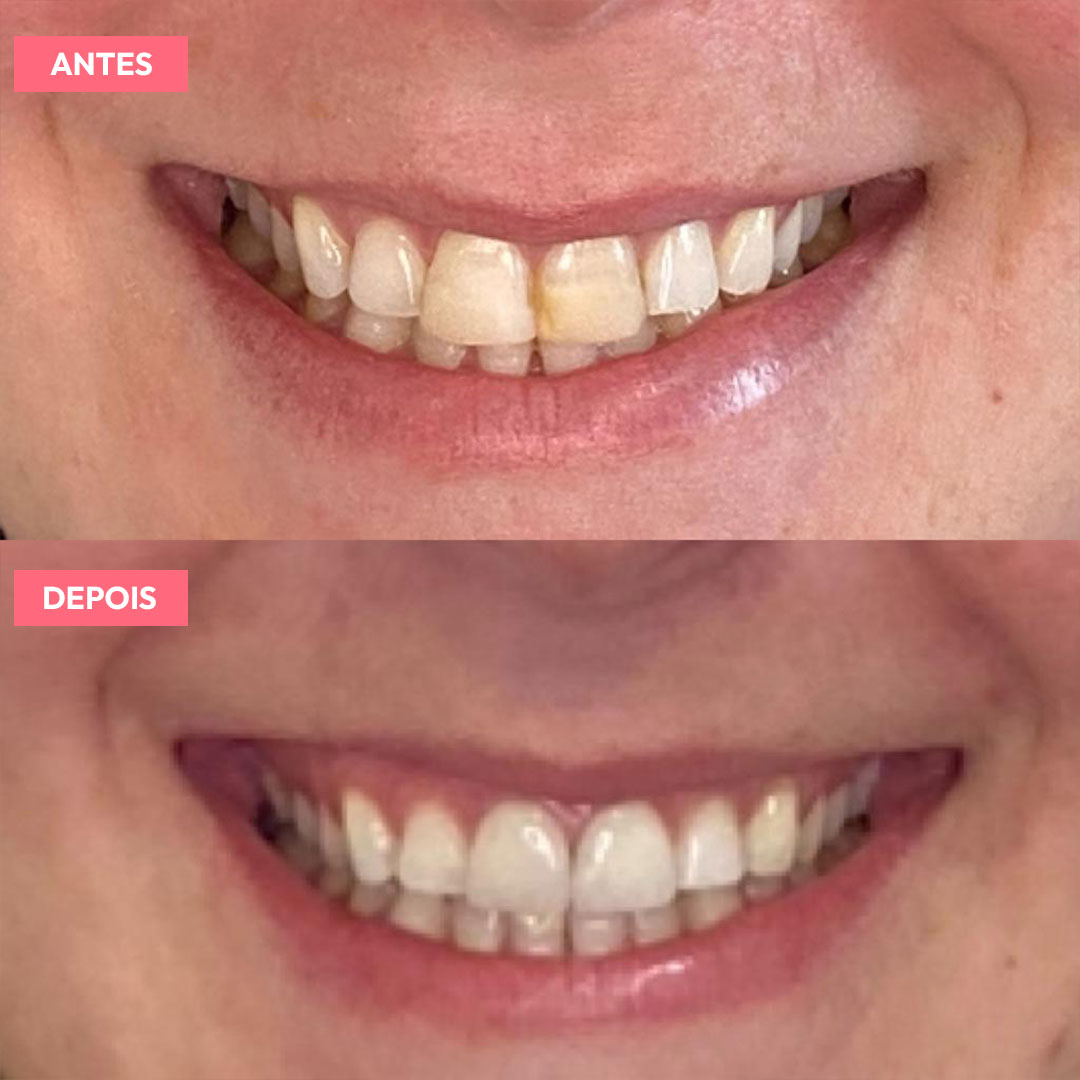 antesdepois-1