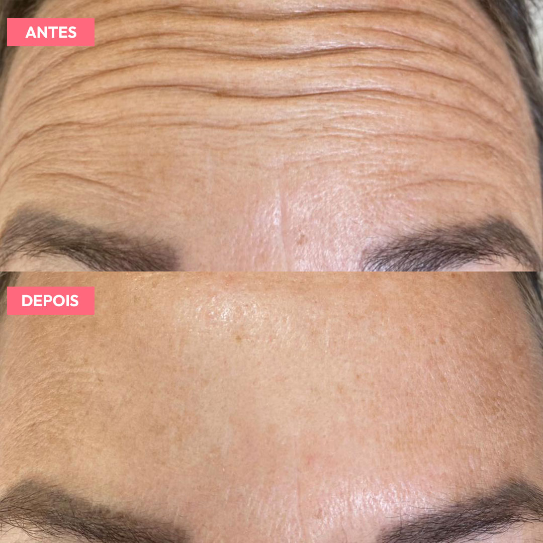 antesdepois-2
