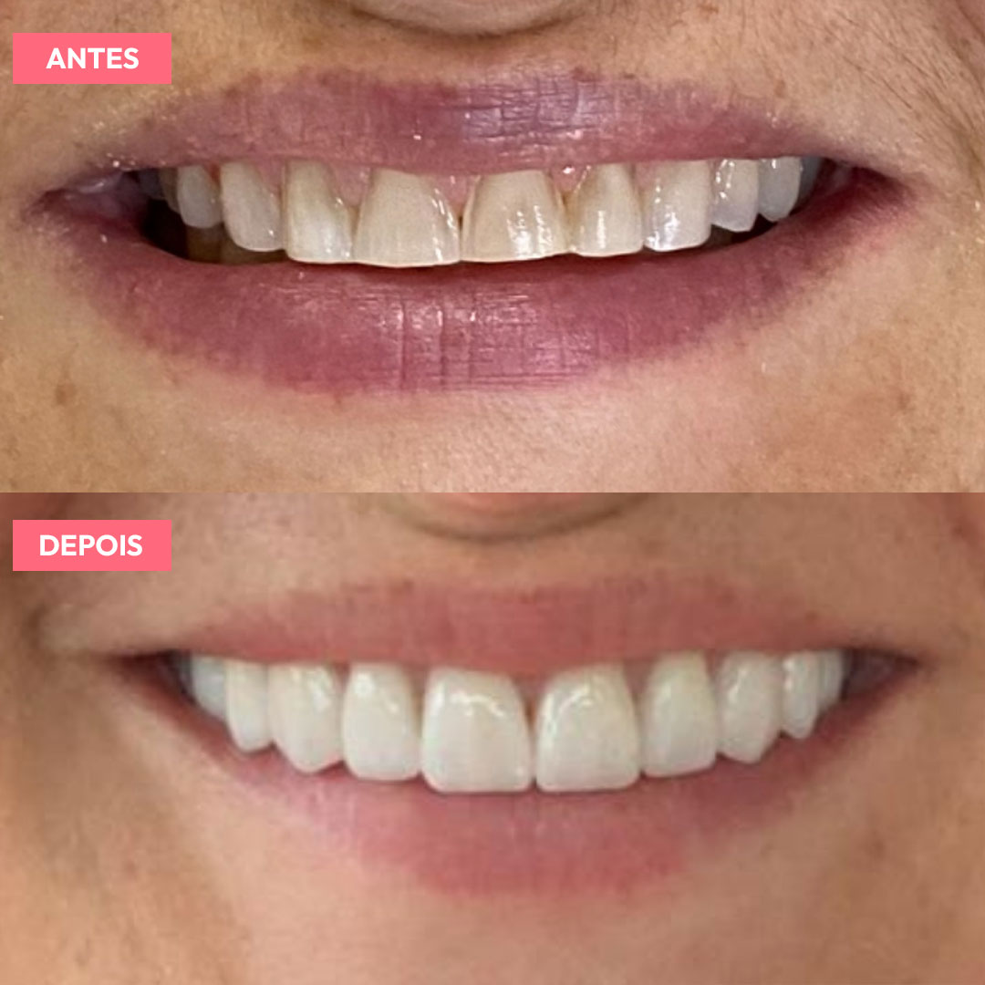 antesdepois-4
