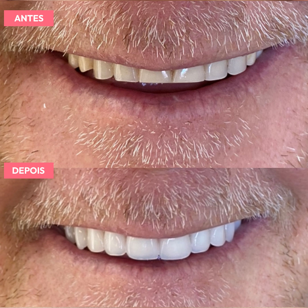 antesdepois-5