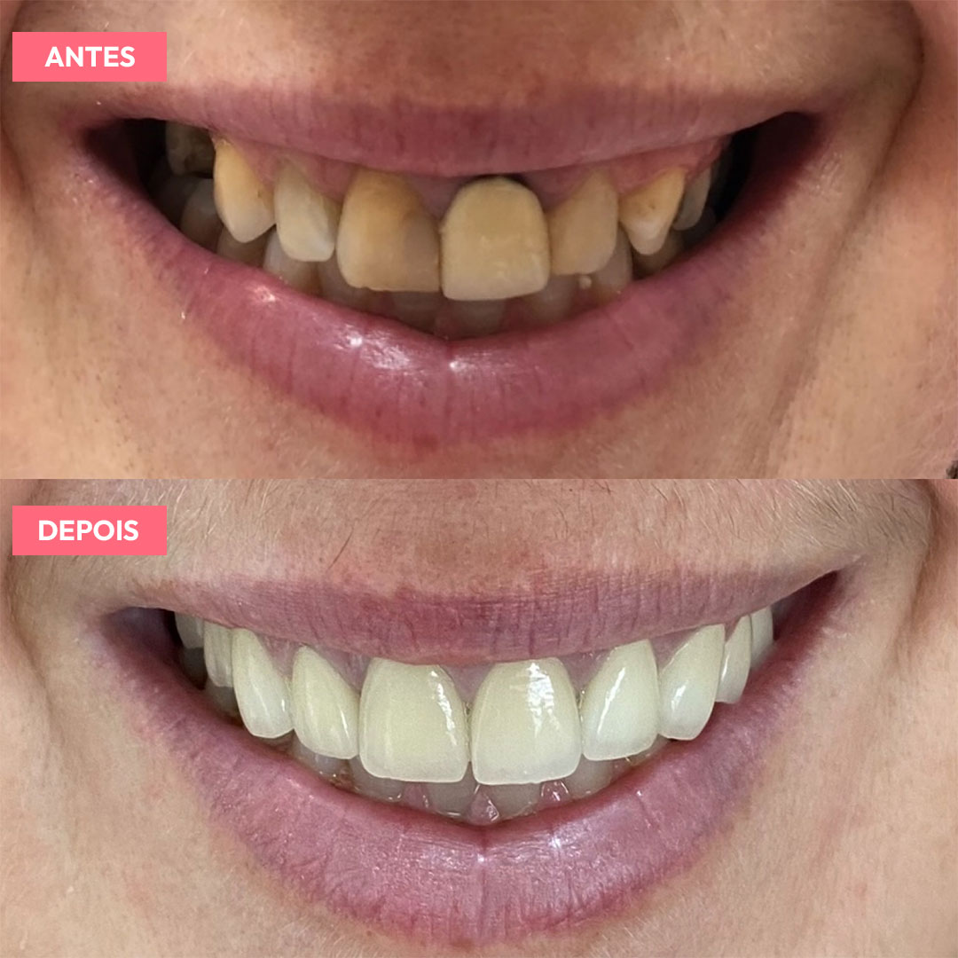 antesdepois-6